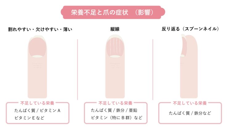 栄養不足と爪の症状のイラスト